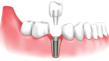 dental-implant