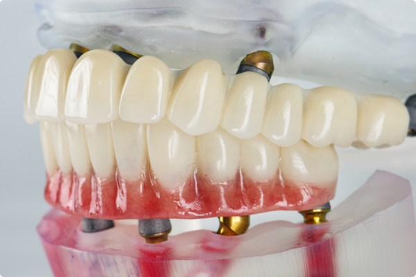 DENTAL IMPLANT