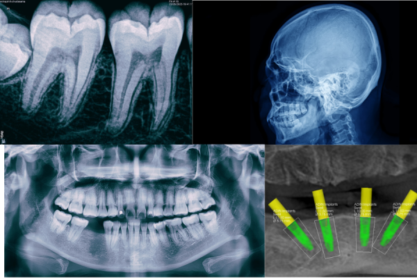 DENTAL X RAYS