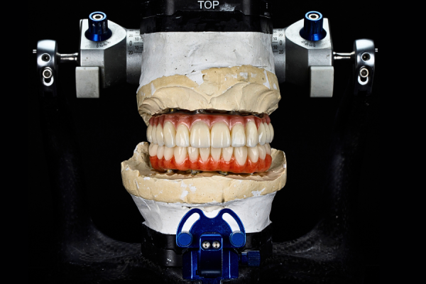 Prosthodontic Treatment
