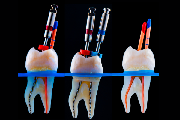 ROOT CANAL TREATMENT
